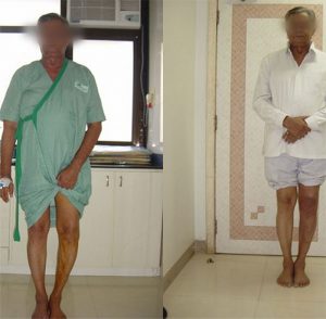 best knee replacement hospital in mumbai