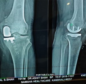 partial knee replacement in mumbai