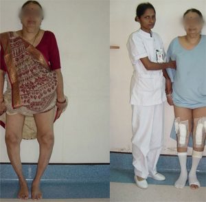 best knee replacement hospital in mumbai