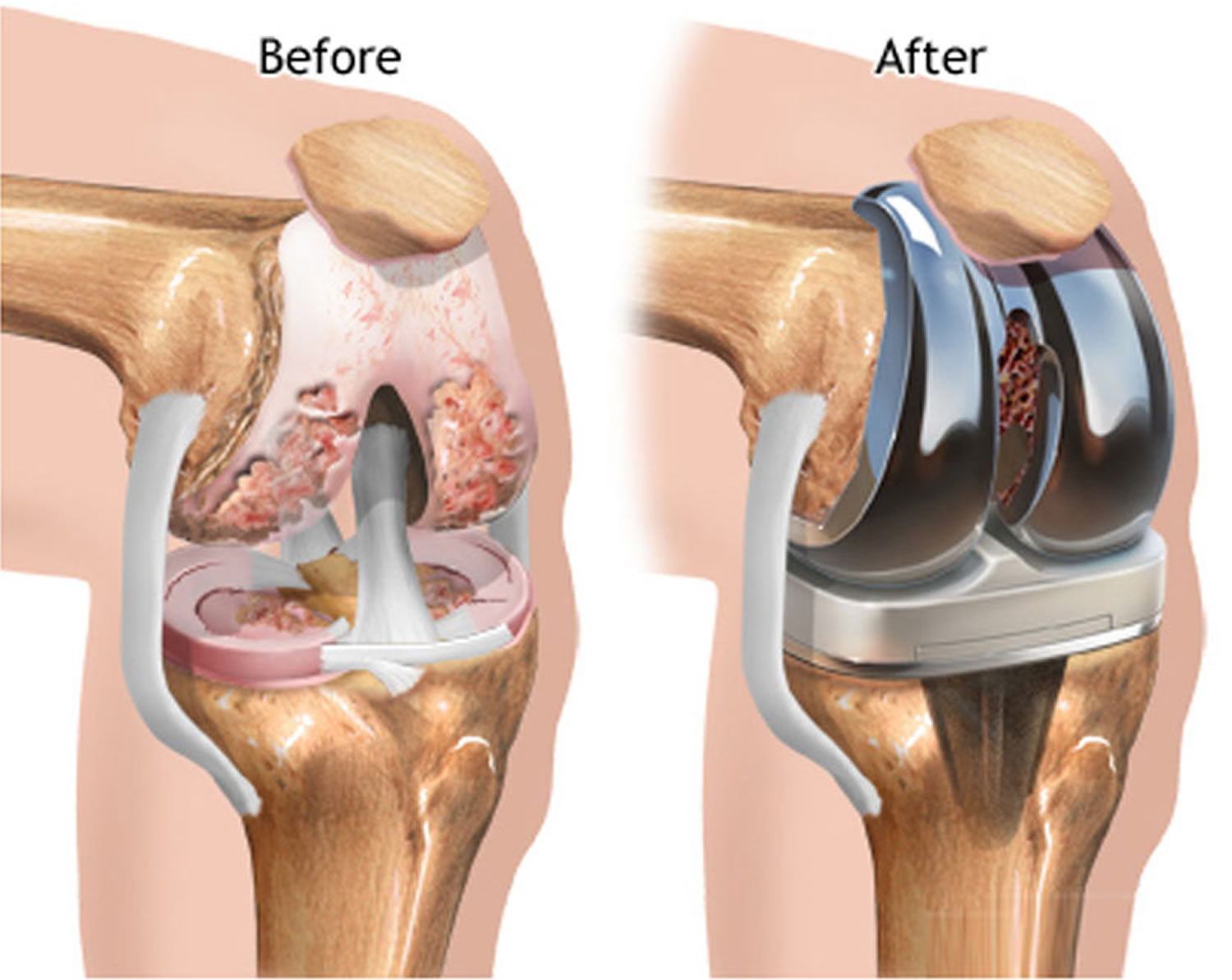 pin-on-knee-replacement