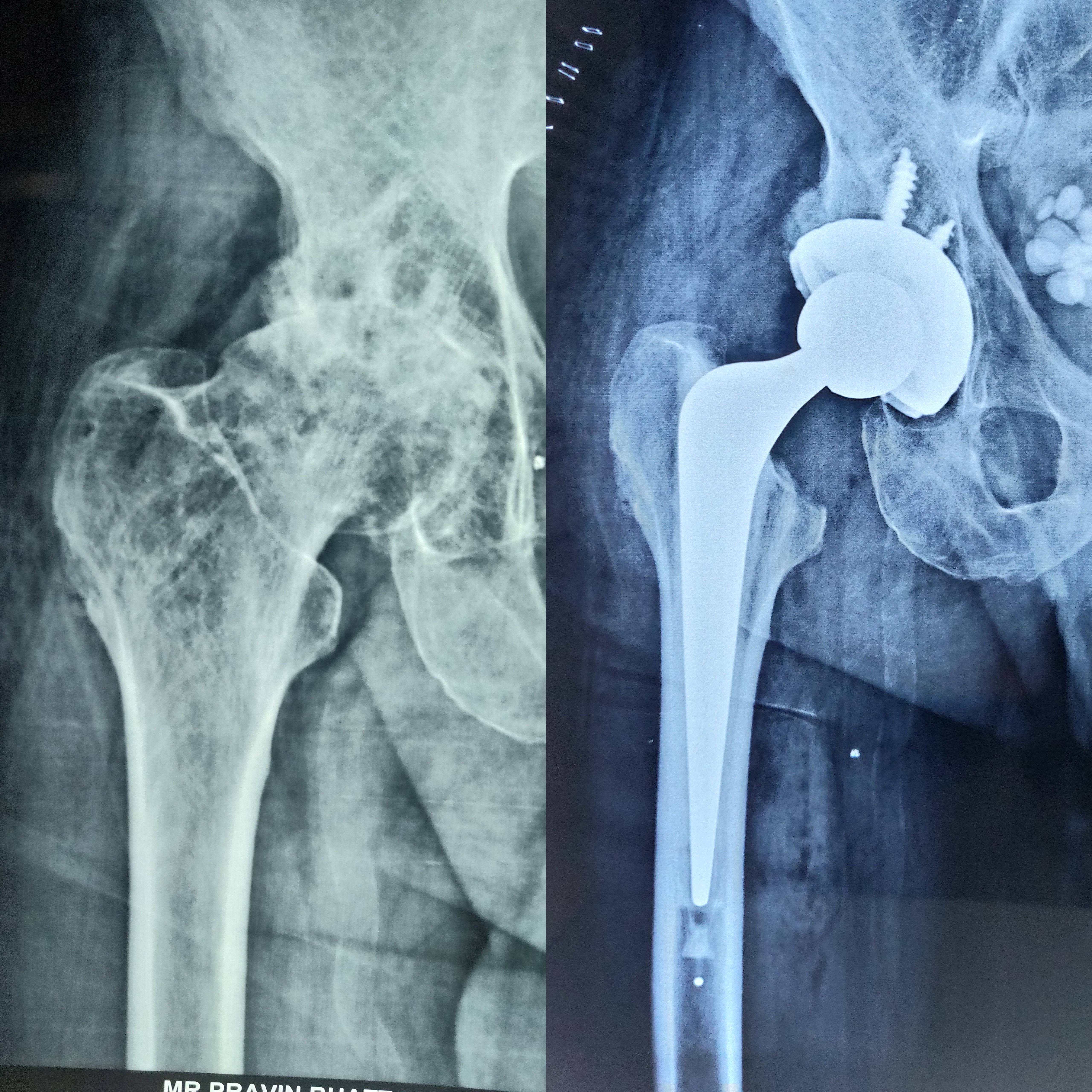 Total Hip Replacement Pic 2 
